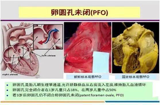 卵圆孔是在胚胎发育期心脏左右心房之间的通道,新生儿出生时,随着第