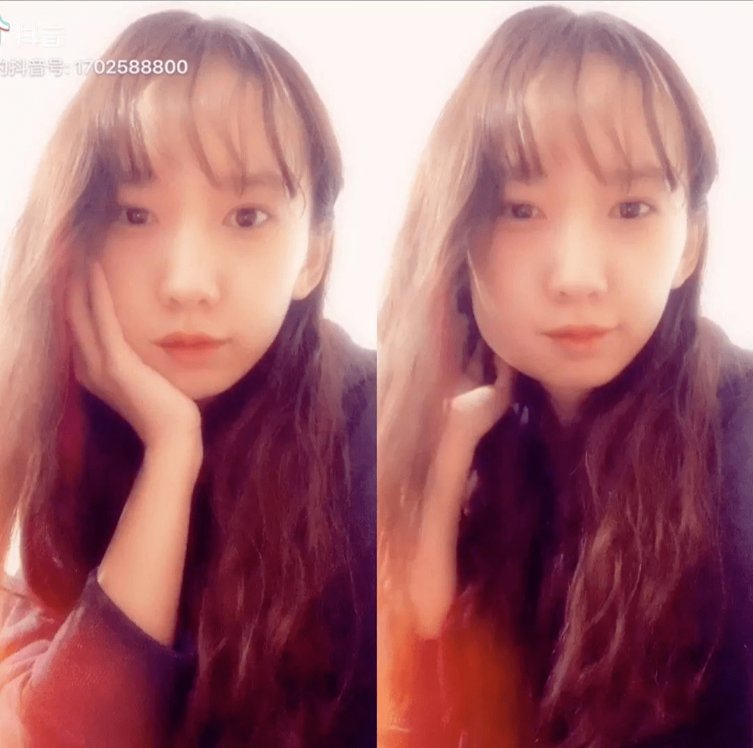 1 正确诊断 正确掌握拔除智齿的适应证,尤其是因为非特异性疼痛考虑