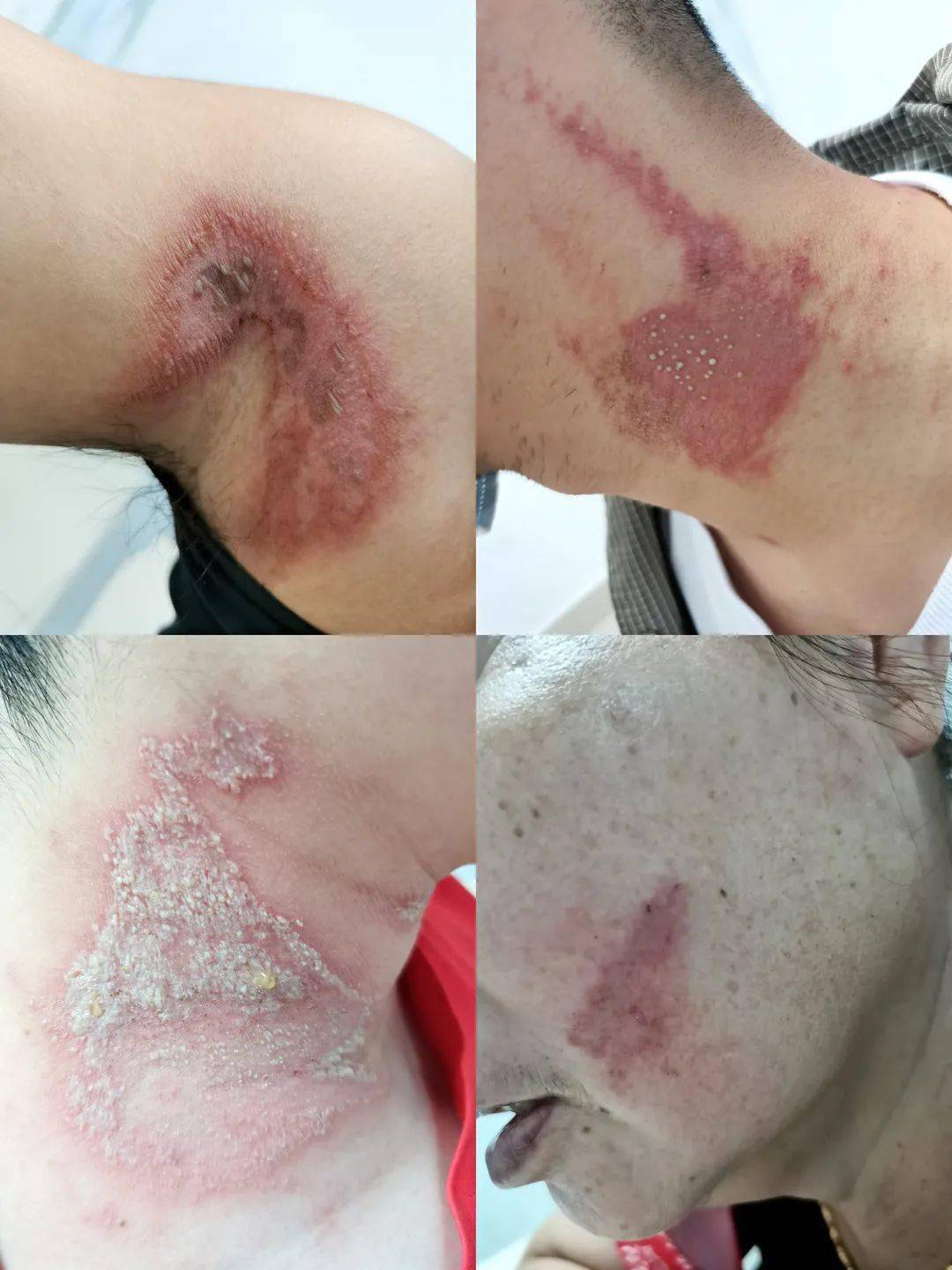 图示不同部位隐翅虫皮炎沾染毒液后怎么处理?1.