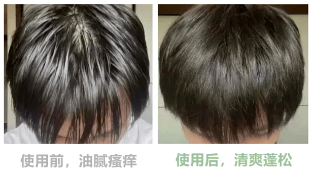 让头屑头油下岗用它洗头爽翻天灵盖头发越洗越清爽柔顺