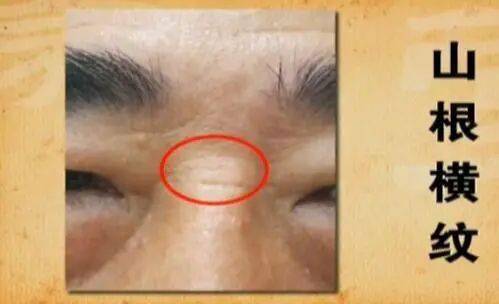 脸上突然出现这3道横纹表明你的心脏正在向你发出警报