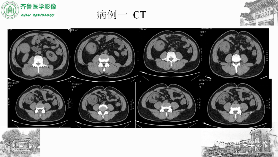 腸套疊影像診斷_文章_平臺_解剖