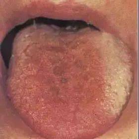 教你看舌诊:61张高清舌诊图谱,图文对照(值得收藏)_舌苔_舌尖_患者