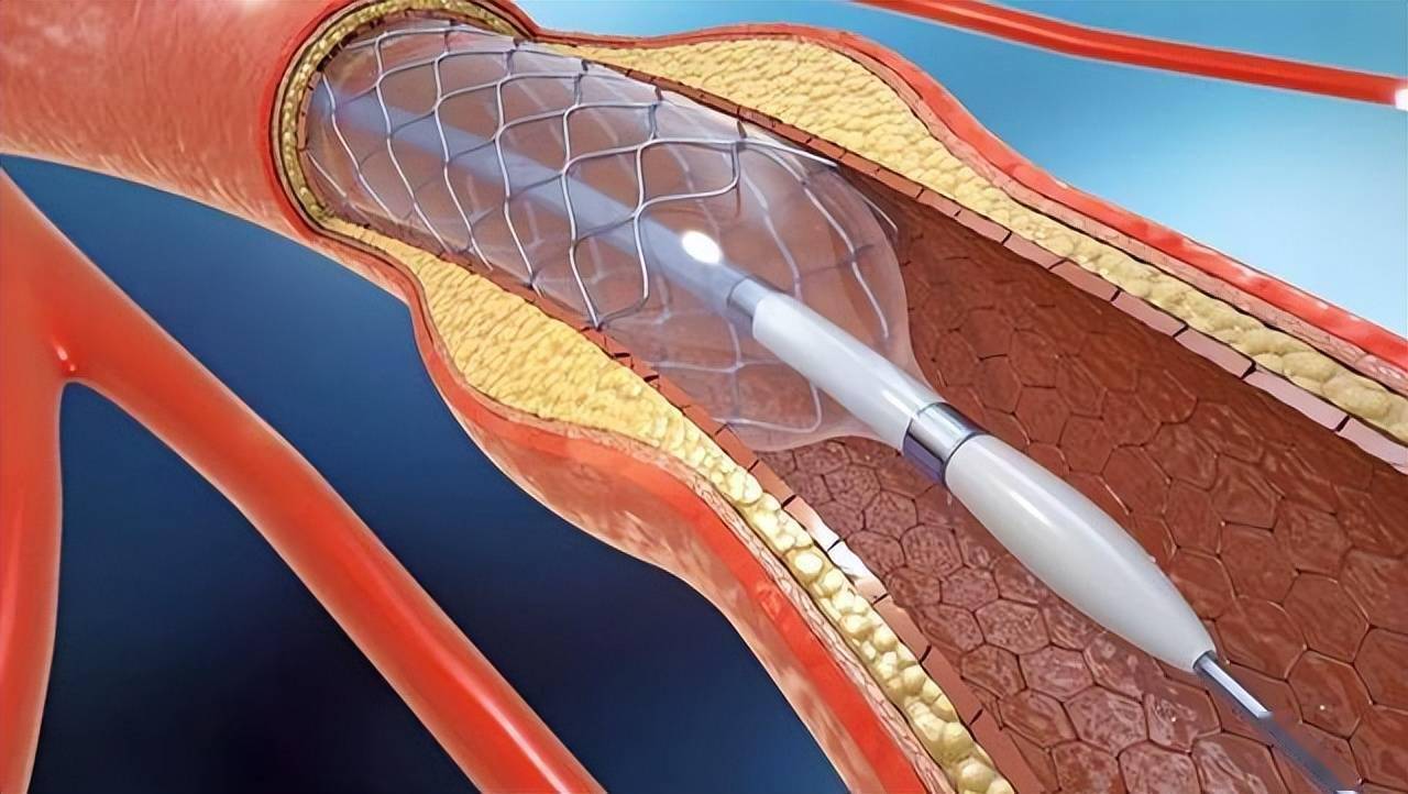 心脏支架装上会对人体有影响吗?你是如何定义支架的用处呢?