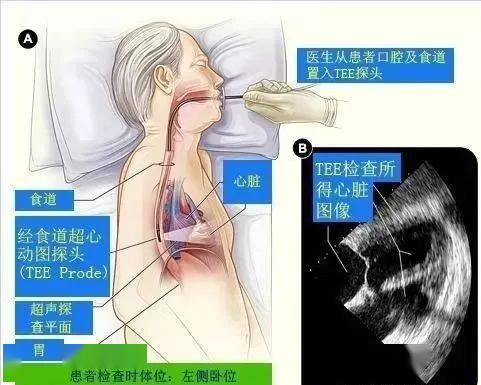 新技术新项目快清准景谷人民医院完成首例经食道超声心动图检查