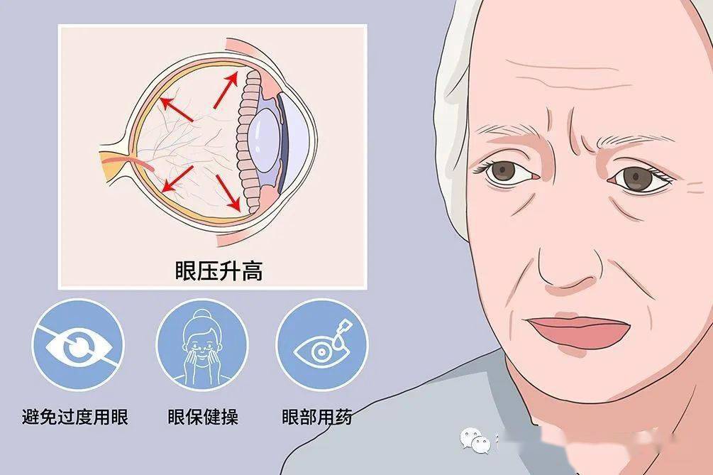 现役飞行员发现高眼压症会被停飞吗