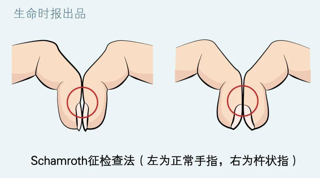 单纯杵状指可去皮肤科,骨科就诊.发现杵状指该怎么办?