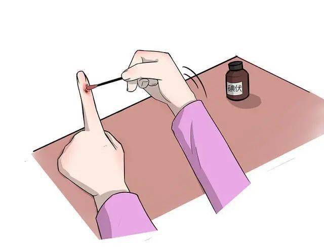 消毒处理:彻底冲洗后用2-3%碘酒(碘伏)或者75%酒精涂擦伤口.