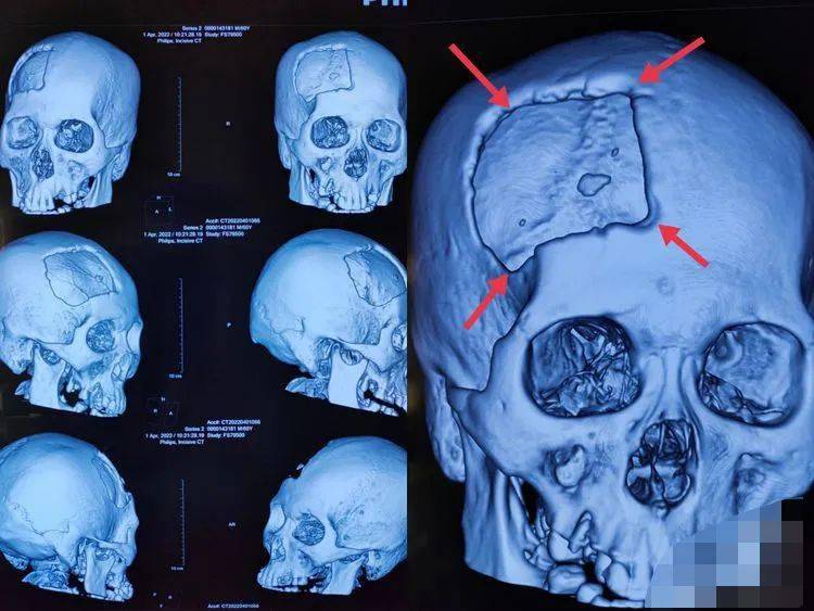 保定第七醫院車禍致顱骨缺損醫生打造鈦金屬頭骨