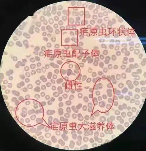 疟原虫配子体图片图片