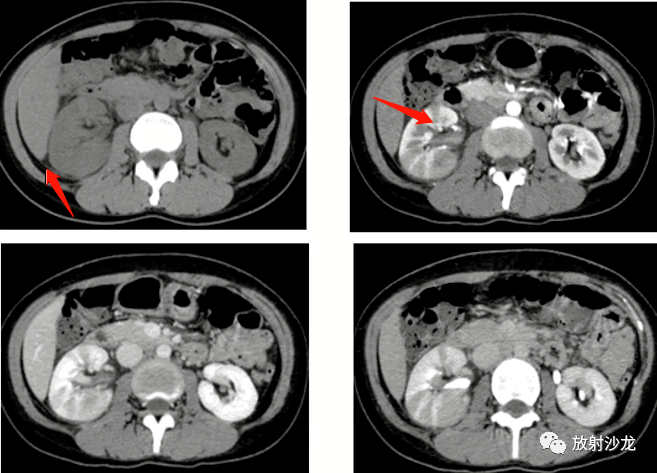 超實用一文總結腎臟急性病變的影像診斷及鑑別