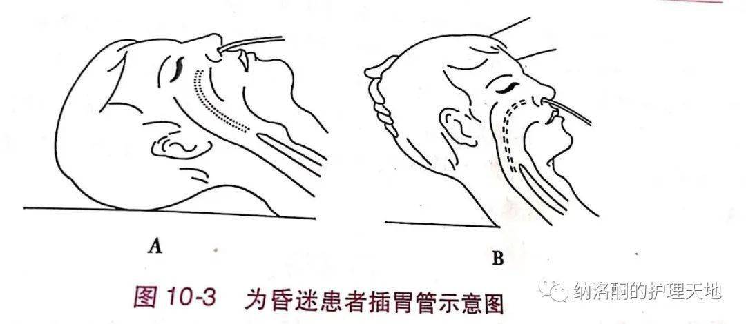 昏迷患者颈项强直不好插胃管,怎么办?教你4种不抬头插管法