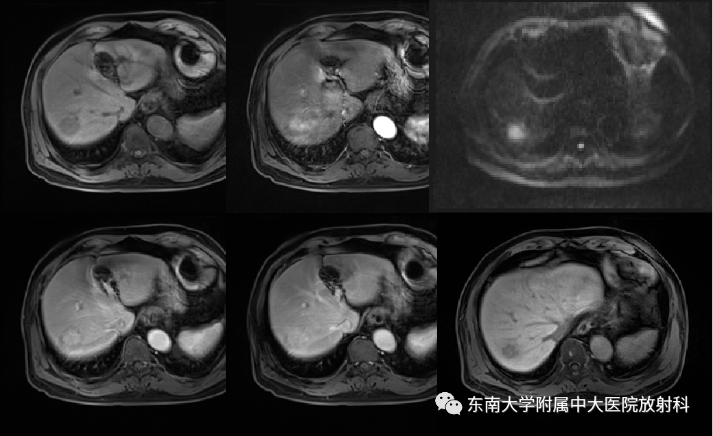 肝臟炎性肌纖維母細胞瘤影像表現_全網_解剖圖_系統