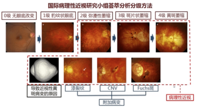 魏文斌教授重中之重提升病理性近视眼综合防治水平