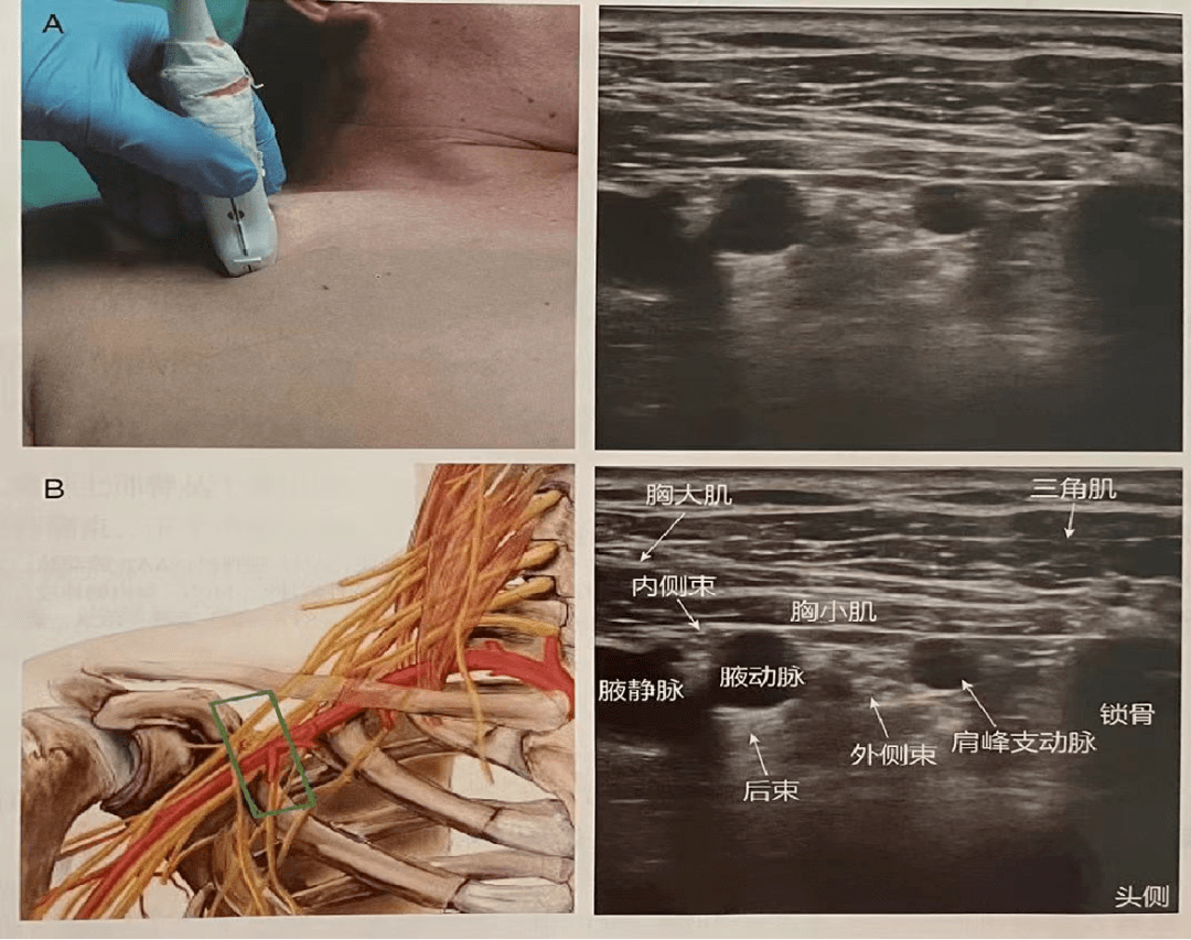 神经阻滞丨超声引导下臂丛神经阻滞