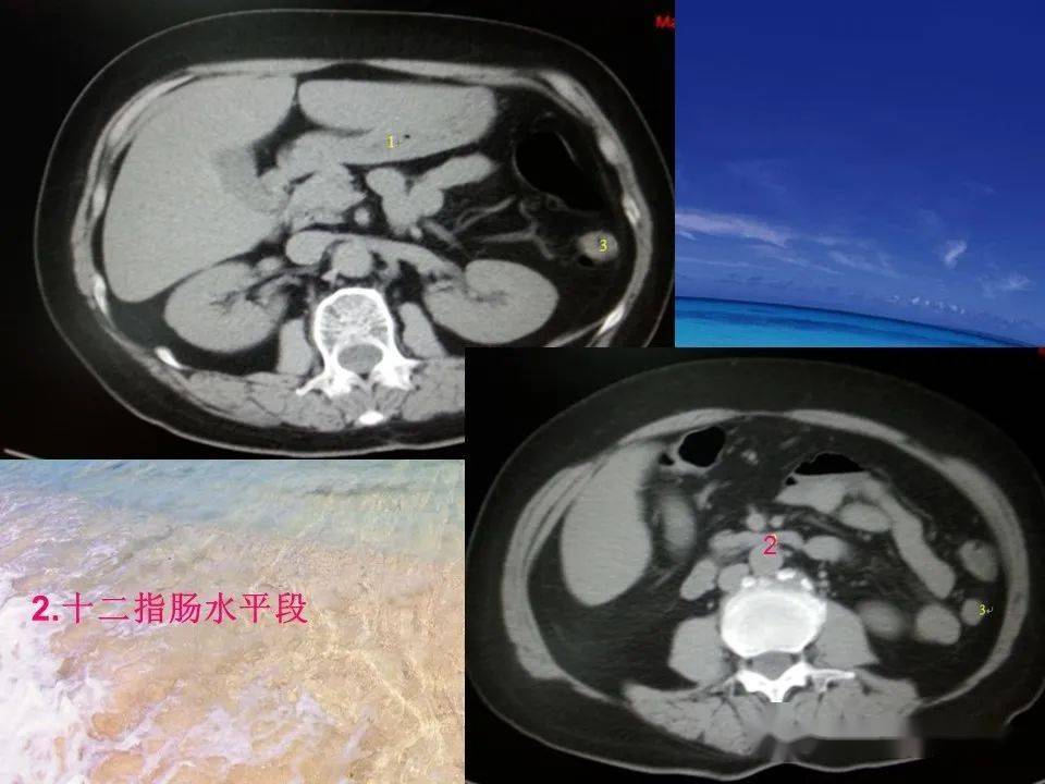 消化道穿孔ct影像大汇总看完印象深刻