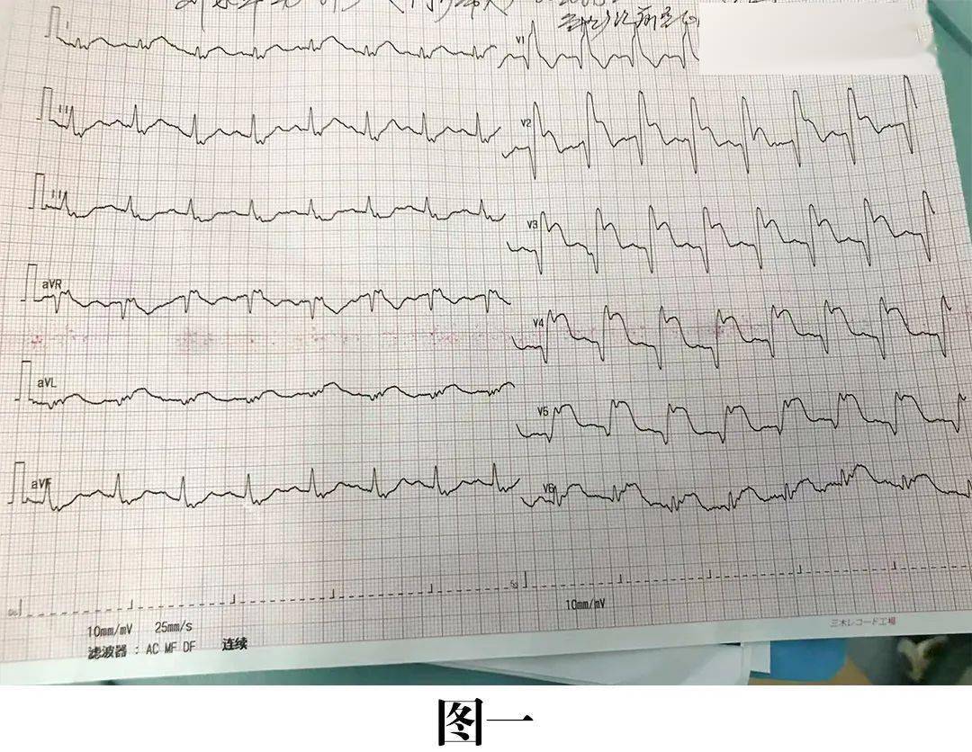 急诊科心电图示"急性广泛前壁心肌梗死",整个心电图呈"墓碑样"抬高