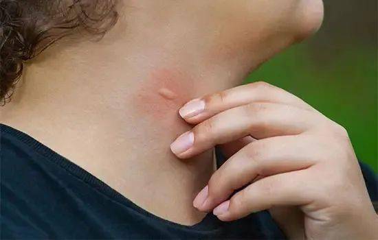 痒就是那里痒,有时它们叮的包还是小红点,一不小心还以为是自己过敏了