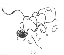 口内缝合术:_张力和_缝线_口腔