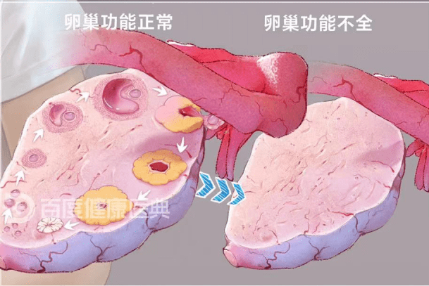 【健康科普】卵巢早衰有预警,未老先衰要不得_女性_月经_遗传