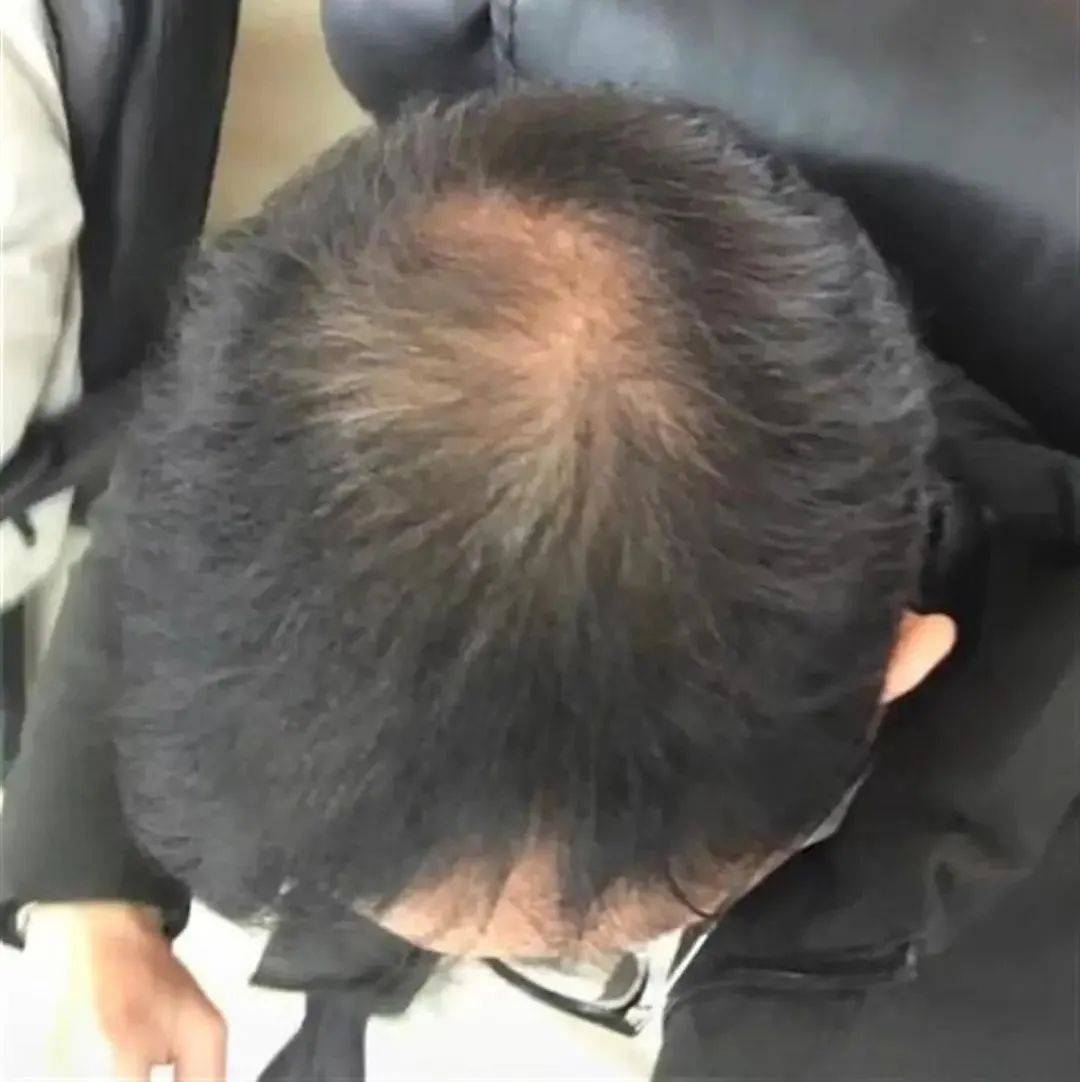 阶段的秃顶。脱发。亚洲男人的简介。插画图片素材_ID:405155767-Veer图库