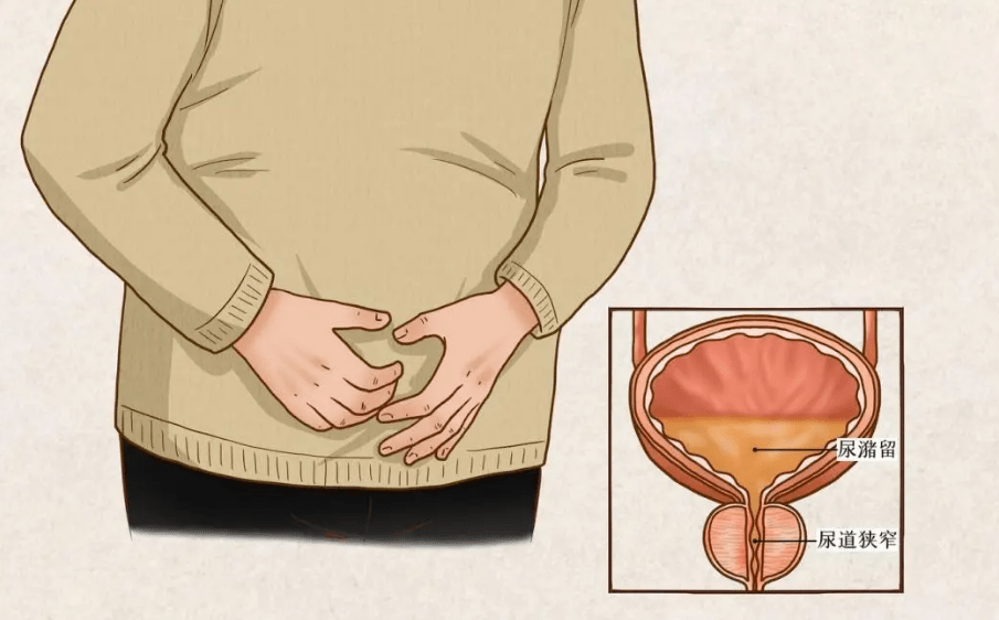男人的这个部位竟会越长越大! 这是病,得治!_前列腺_厕所_膀胱