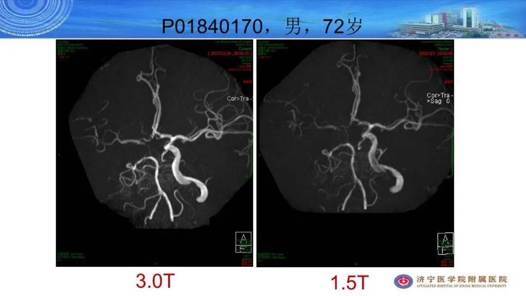颅脑mra诊断要点及报告模板