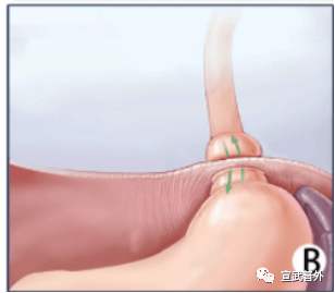 食管裂孔疝a环b环位置图片
