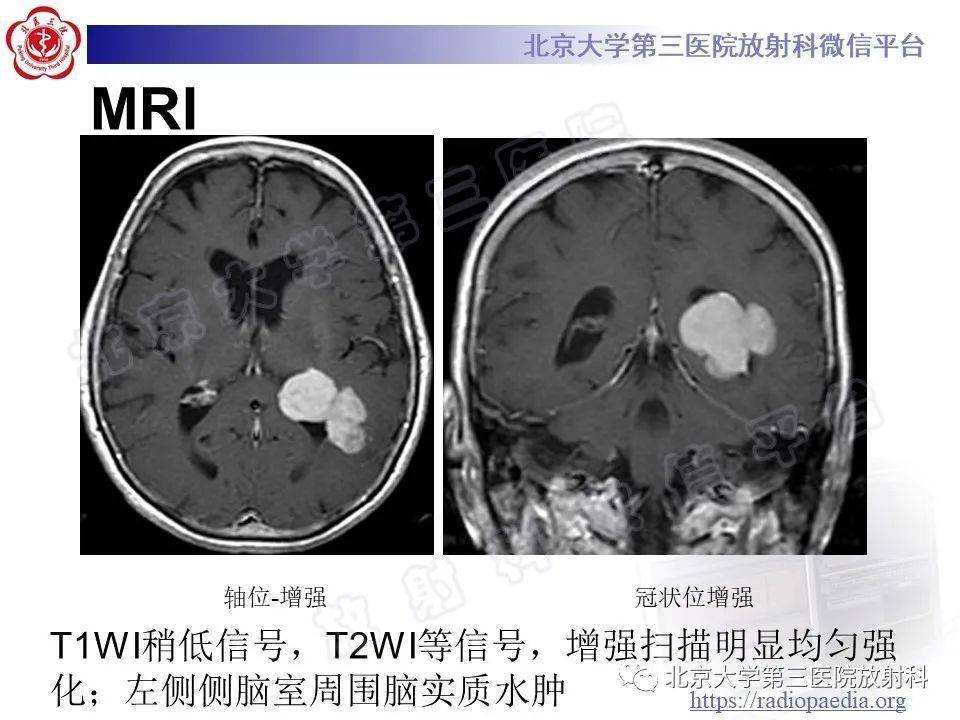 脑膜瘤核磁共振图片图片