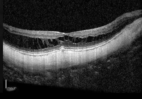 正常黄斑近视性黄斑劈裂不同于正常黄斑,会出现拉丝面包一样的改变