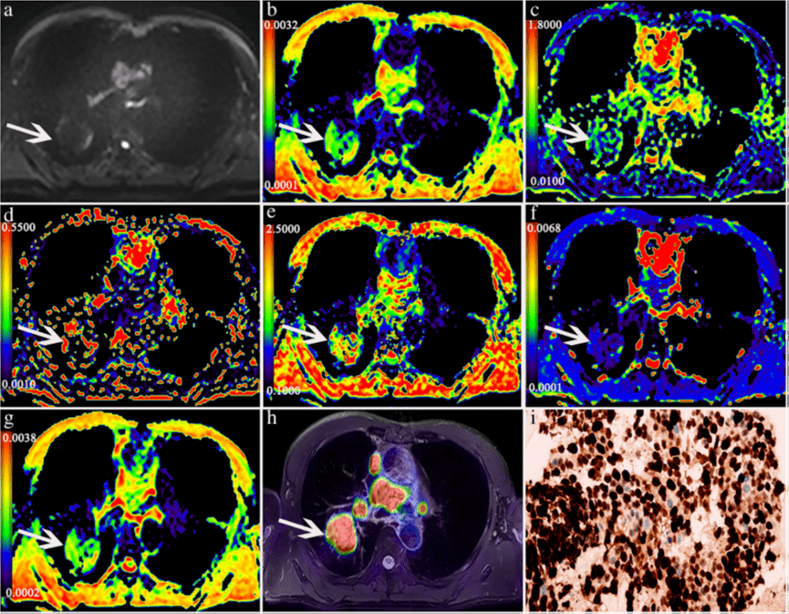 【学术】王梅云教授团队 | pet/mr在肺癌诊断分型中的应用_细胞_亚型