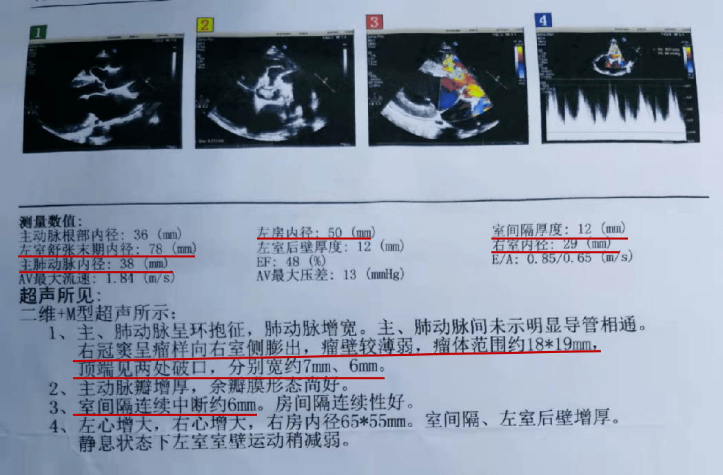 主动脉窦瘤超声图片