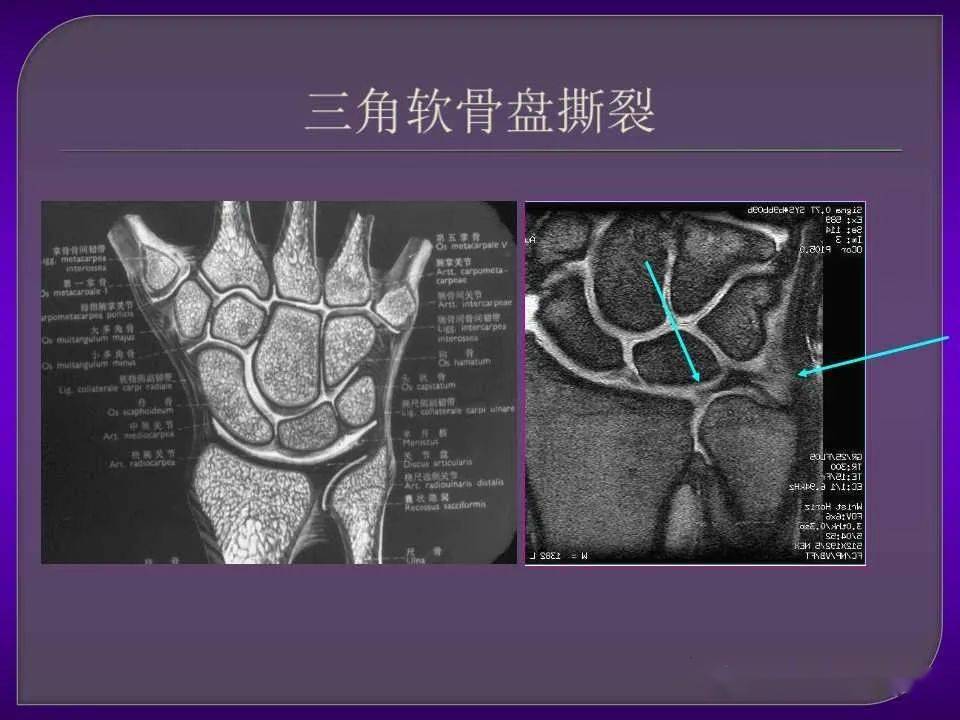 详细篇腕关节解剖及常见病变mri表现