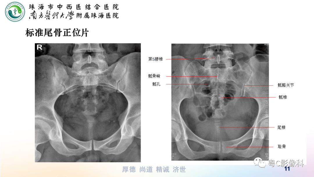 骶尾椎侧位图片