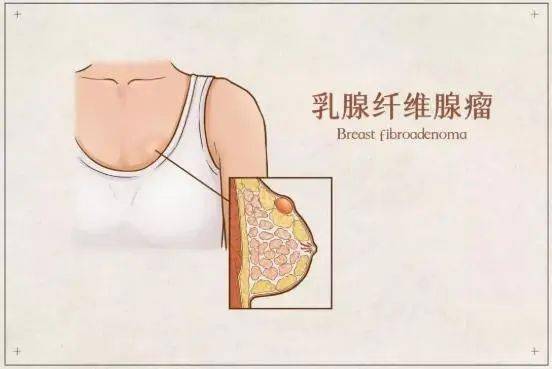 先做這件事_乳腺_艾灸_淋巴結