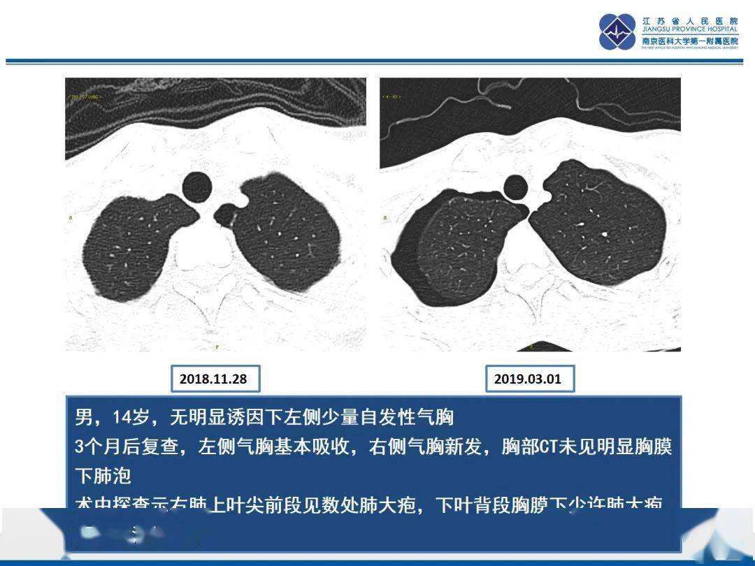 少見的自發性縱隔氣腫病例2.詳細篇:腕關節解剖及常見病變mri表現3.