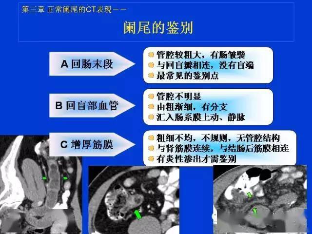 全面详解正常阑尾和阑尾炎的ct表现