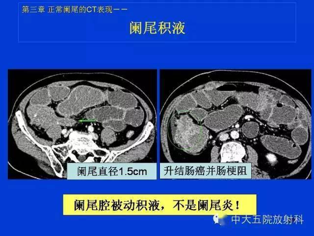 全面詳解正常闌尾和闌尾炎的ct表現