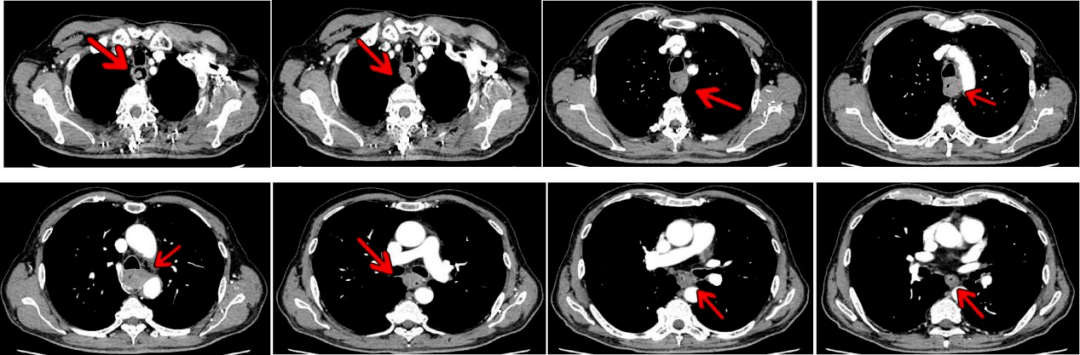 增强ct(2021-04-14):食管中段管壁不规则增厚,管腔狭窄,纵隔淋巴结