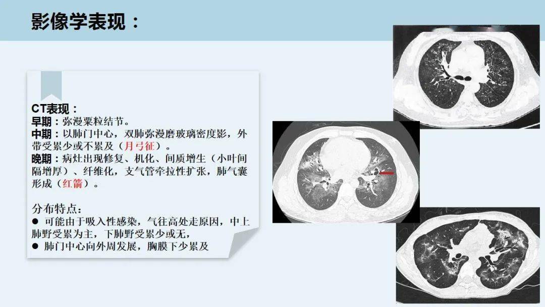 肺孢子菌肺炎的临床及影像特点