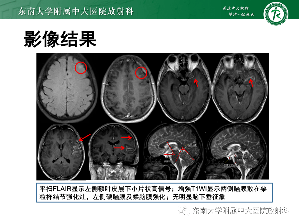 低顱壓綜合徵的mri表現_檢查_影像_解剖圖