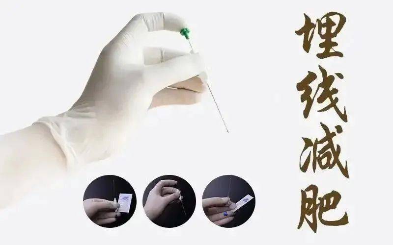 效果杠杠的埋线减肥专病门诊开诊啦