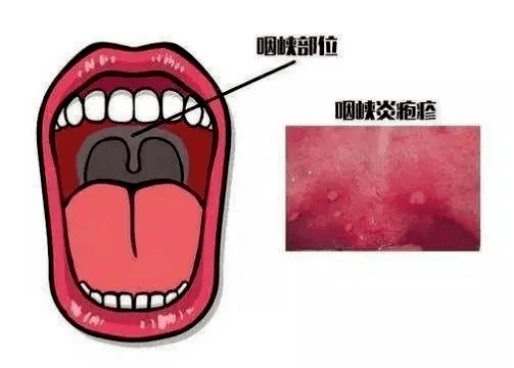 家长注意疱疹性咽峡炎来袭和手足口病是同一家门的防治看这里
