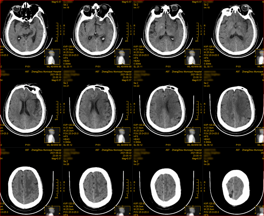 陈文伙教授团队专栏丨术前多时相cta影像评估指导t字部双支架取栓1例