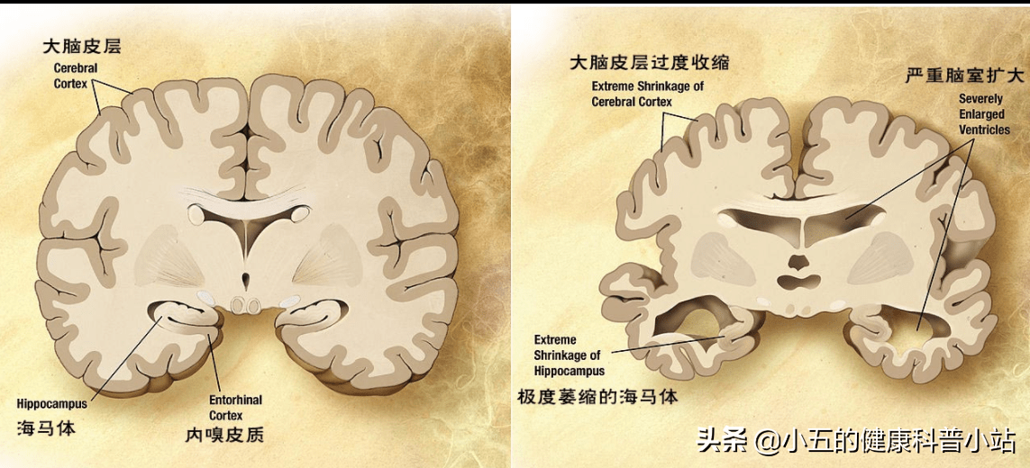 大脑有事记忆力先知注意5种异常表现或是老年痴呆早期信号