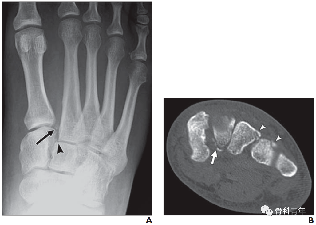 第2跖骨基底撕脱骨折或内侧楔骨撕脱骨折通常提示lisfranc损伤