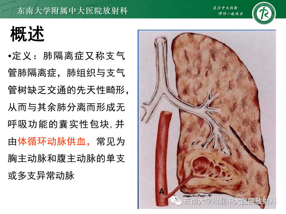 肺隔离症 先天性图片