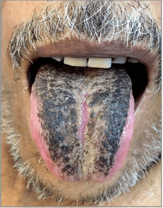 舌头根部长疙瘩图片