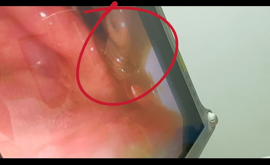 5月17日下午,我院眼耳鼻喉科接诊一咽部异物感,声音嘶哑女性患者.