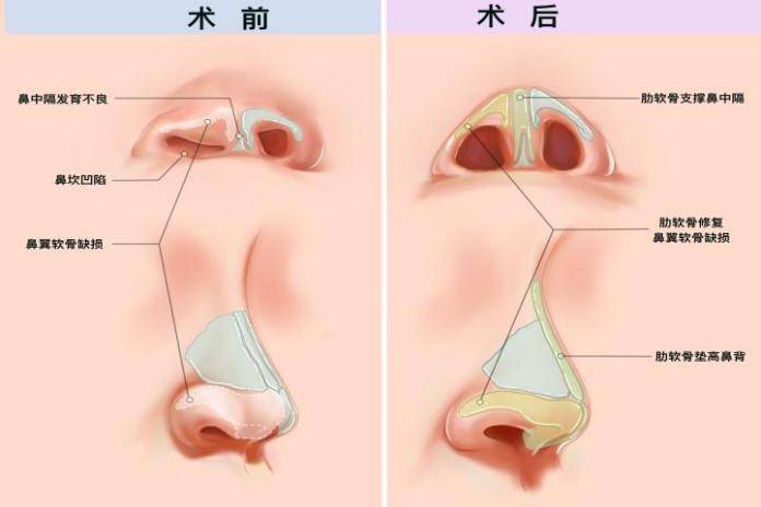 鼻子中间软骨凹下去图片